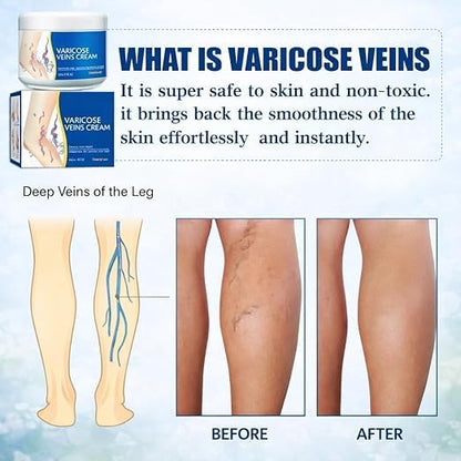 Varicose Veins Relief Cream