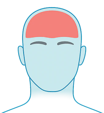 Migraines